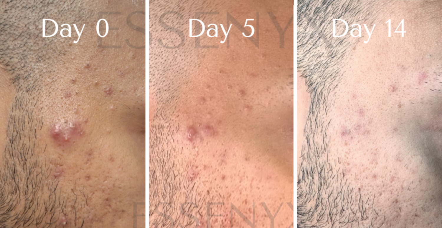 Acne — Acne Recovery Serum (Severe Lesions)