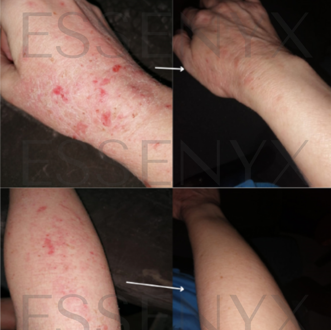 Eczema-prone flare visibly calmed within a few weeks | This result was achieved using the Bio-Barrier Reset Serum — a breathable, mineral-powered treatment designed to soothe chronic flare-prone skin and support barrier recovery. No steroids. No oils. No rebound flares. Just real results through biologically intelligent care.