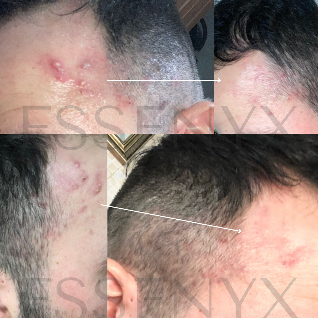 Visible Recovery in Just 10 Days | This severe acne transformation was achieved using the Acne Recovery Serum — our high-potency treatment for cystic and inflamed skin. Powered by ultra-refined minerals and antimicrobial botanical waters, it clears pores, calms redness, and speeds up skin repair — without acids, benzoyl peroxide, or irritation.