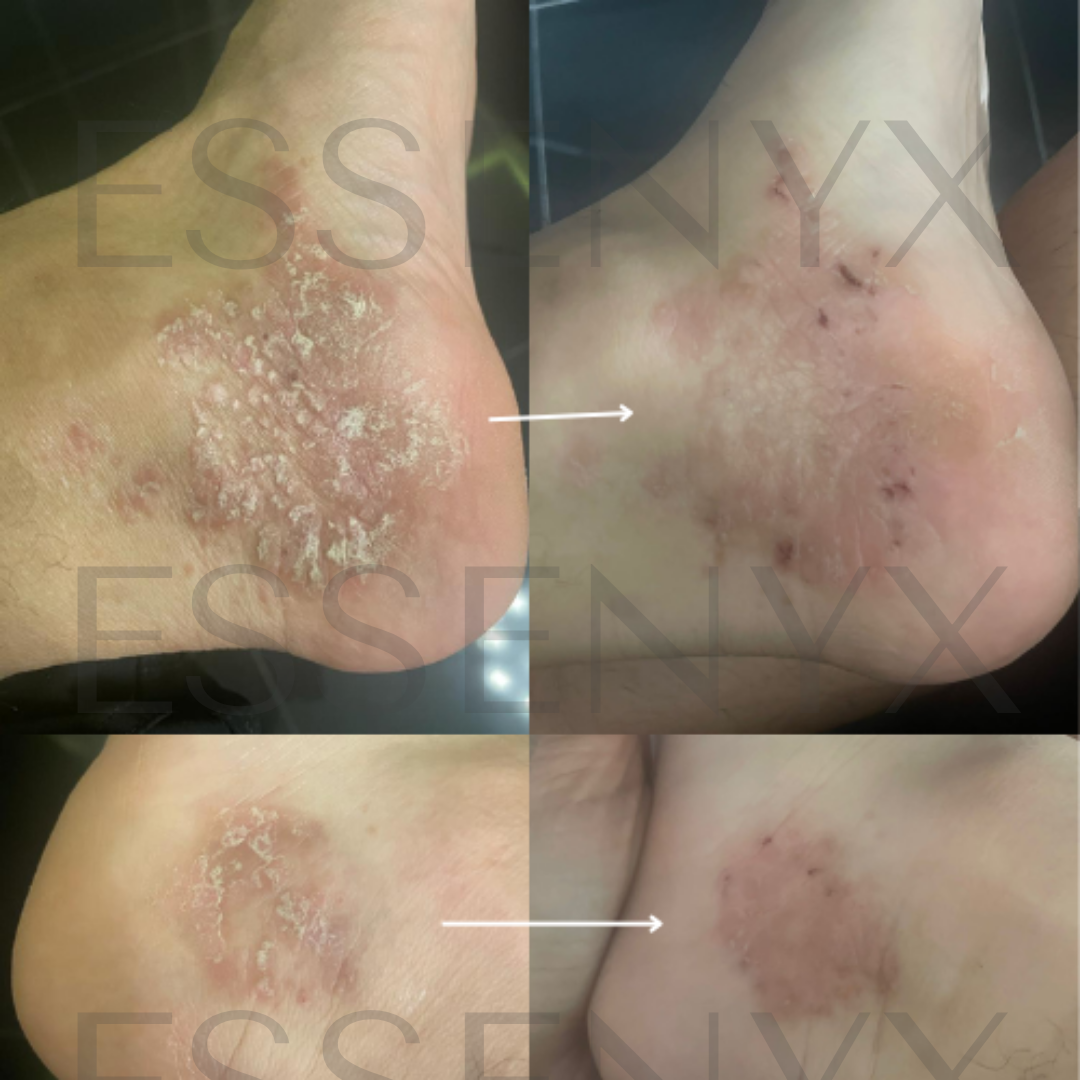 Visible Psoriasis Relief in a Few Days | This improvement was achieved with the Dermal Equilibrium Serum — our daily-use treatment for psoriasis, seborrheic dermatitis, and fungal-prone skin. Powered by ultra-refined minerals and targeted botanical waters, it reduces redness, smooths scaling, and restores clarity without steroids, acids, or oils.