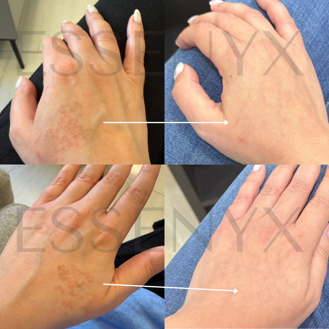 Full Relief in Under a Week — With Inconsistent Use | This mild eczema recovery was achieved using the Bio-Barrier Reset Serum — our breathable, mineral-powered solution for flare-prone skin. Even without daily use, it restored smooth, healthy skin fast — no steroids, no oils, no irritation.