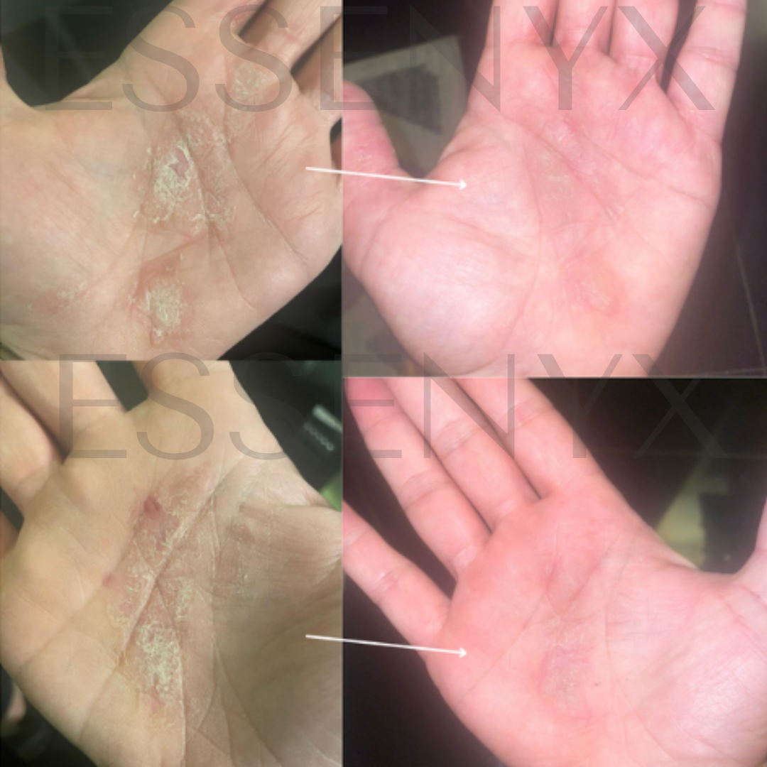 Visible Psoriasis Relief in a Few Days | This improvement was achieved with the Dermal Equilibrium Serum — our daily-use treatment for psoriasis, seborrheic dermatitis, and fungal-prone skin. Powered by ultra-refined minerals and targeted botanical waters, it reduces redness, smooths scaling, and restores clarity without steroids, acids, or oils.