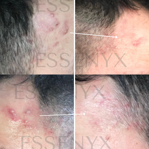 Acne — Acne Recovery Serum (Severe Case)