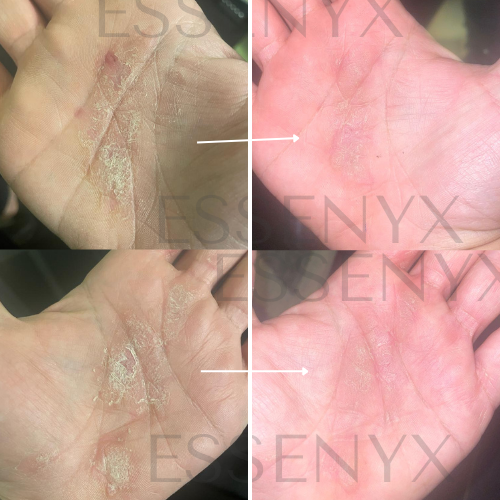 Psoriasis — Dermal Equilibrium (Palm Case)