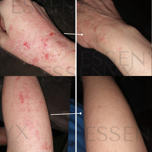 Eczema — Bio-Barrier Reset Serum (Severe Arms Case)