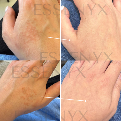 Eczema — Bio-Barrier Reset Serum (Hands Case)