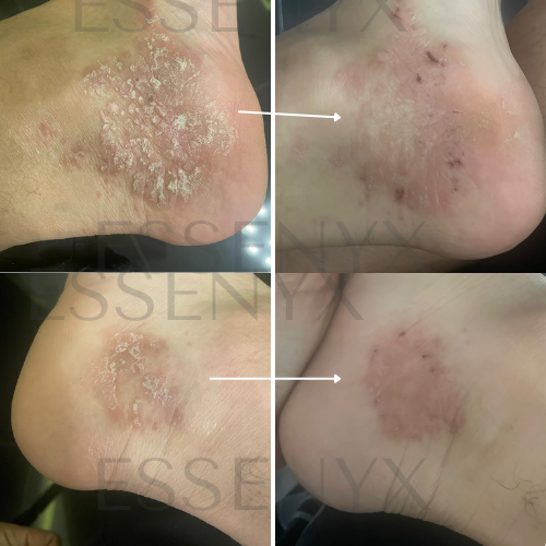 Psoriasis — Dermal Equilibrium (Ankle / Shoe Comfort Case)