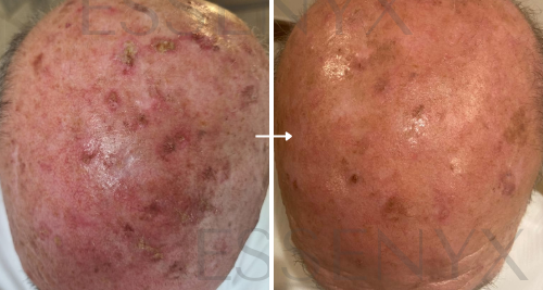 Seborrheic Dermatitis — Dermal Equilibrium Mist (Full Scalp Case)