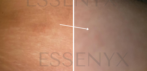 Eczema — Bio-Barrier Reset Serum (Thigh / Discoloration Case)