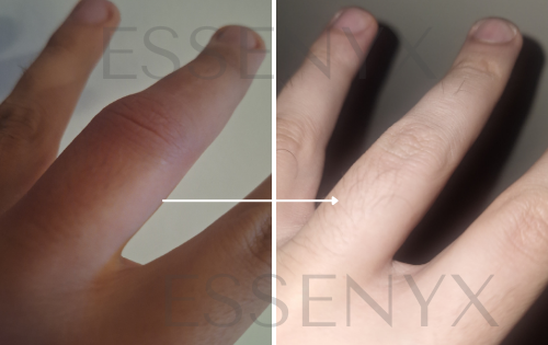 Spider Bite — Outdoor Rescue Mist (Finger Case)